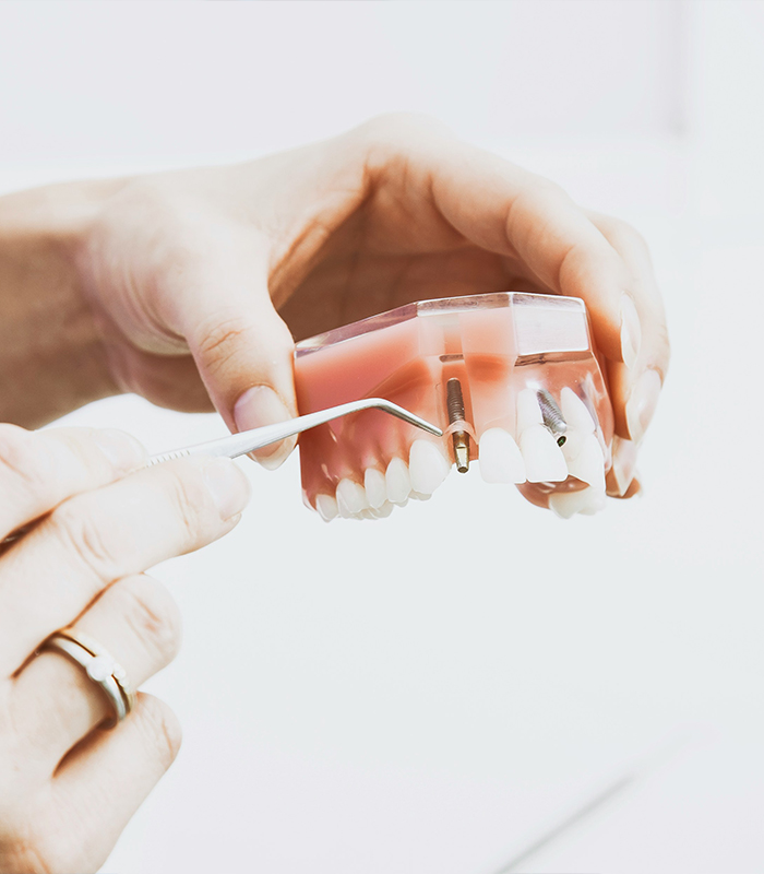 Dental Implants